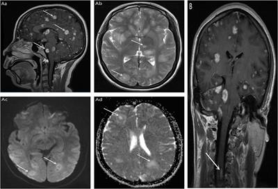 Misdiagnosis of HIV With Toxoplasmosis Encephalopathy With Progressive Memory Loss as the Initial Symptom: A Case Report